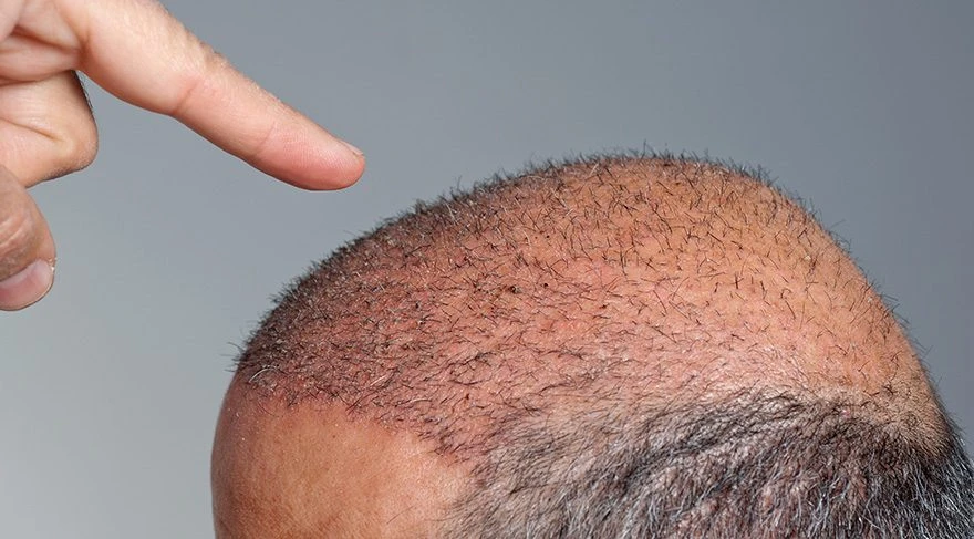 Erkeklerde Saç Ekimi Yaptırmadan Önce Dikkat Edilmesi Gerekenler?
